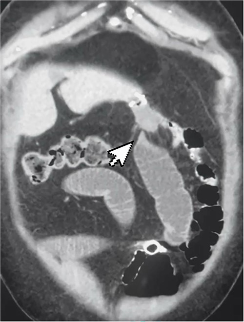 CT scan showing high-grade small bowel obstruction and twisting at the gastro-jejunal anastomosis.