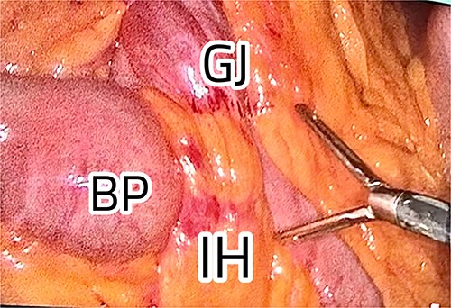 IH at the gastro-jejunal anastomosis.