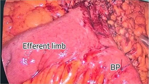 Restoration of the anatomy, fixation, and closure of Petersen’s space.