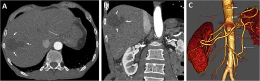 Preoperative axial (A) and coronal (B) CT angiographic images demonstrate hypoenhancement of all of the hepatic parenchyma and hypodense, hepatic lesion measuring 48 × 47 × 34 mm in the segment V and VI (arrows). (C) 3D reconstructed CT angiography shows occlusion of the celiac and superior mesenteric arteries (thick arrows) and hypertrophy of the inferior mesenteric artery and artery of Drummond (thin arrow).
