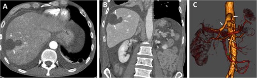 Postoperative axial (A) and coronal (B) CT angiographic images demonstrate enhancement during contrast-enhanced phase and hepatic ischemic area with irregular margins. (C) 3D reconstructed CT angiography shows antegrade visceral reconstruction with a bifurcated graft from the supra-celiac aortic donor to the superior mesenteric and celiac arteries (arrows).