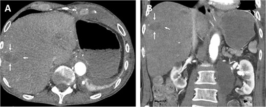 Follow-up (46 months after liver infarction) axial (A) and coronal (B) CT angiographic images demonstrate a stable hepatic infarction lesion 33 × 18 × 20 mm (arrows).