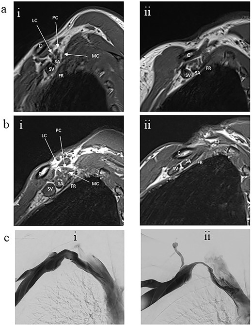 Panel a. Sagittal T1-weighted MRI of the costoclavicular space without imaging evidence of nTOS. Arm alongside the body (i) and arm elevated (ii). Maintenance of a fat plane surrounding the cords is seen with physiological narrowing of the space. Panel b. Sagittal T1-weighted MRI of the costoclavicular space with imaging evidence of nTOS. Arm alongside the body (i) and arm elevated (ii). Narrowing of the costoclavicular space and complete effacement of the fat indicating brachial plexus compression. Panel c. Venograms conducted with contrast injection in the antecubital vein while the arm is alongside (i) and in salute pose (ii) demonstrates tight stenosis of the subclavian vein and collateral flow. The MRI also showed effacement of the brachial plexus. The 36 year-old male subject had an excellent outcome after excision of the 1st rib. C: Clavicle; FR: First rib, SV: Subclavian vein, SA: Subclavian artery, LC: Lateral cord, MC: Medial cord, PC: Posterior cord.