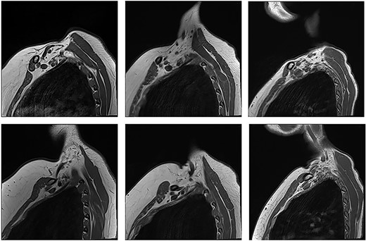 Unaffected patients. The top row are sequences with the arm in the neutral position. The bottom row is the corresponding patient with the arm raised.