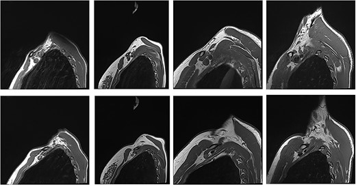 Patients with nTOS. The top rows are sequences with the arm in the neutral position. The bottom row is the corresponding patient with the arm raised.