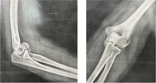 Preoperative standard anteroposterior and lateral X-rays.