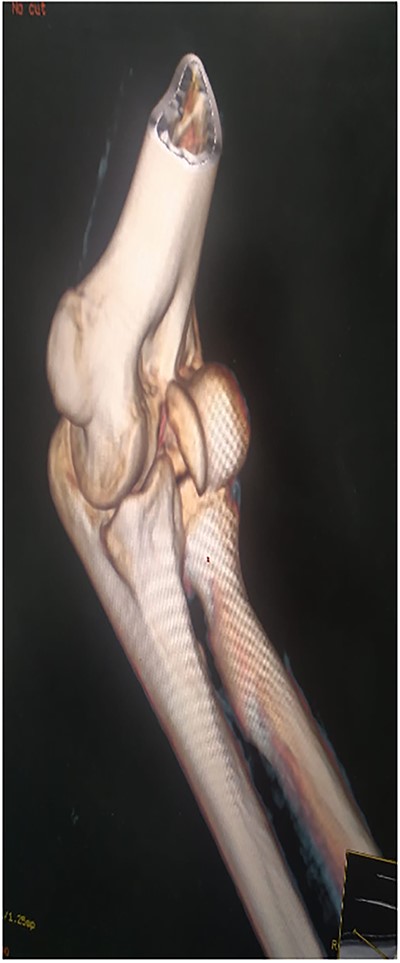 Preoperative CT scan with 3D reconstruction.