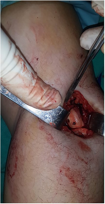 Last visual inspection of the fracture.