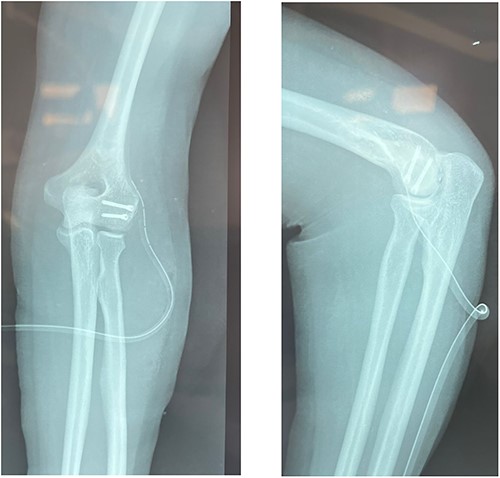 Postoperative X-rays.