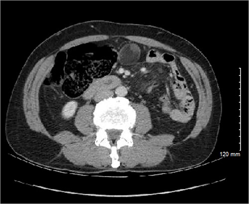 Initial CT imaging showing an extraluminal mass, measuring 3.6 × 3.0 × 3.9 cm with mural soft tissue nodularity within the midline anterior abdomen.