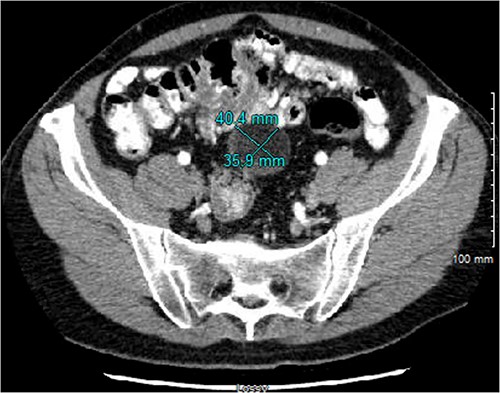 CT imaging from 4 months after initial diagnosis, showing a 4.0 × 3.6 × 3.8 cm, seemingly lipomatous mass in the midpelvis.