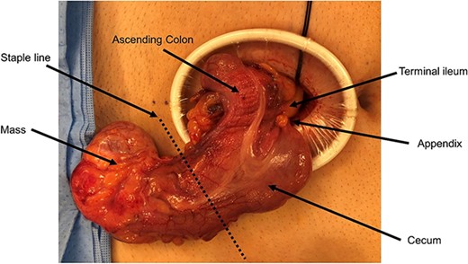 Intraoperative imaging of cecal cystic lesion.
