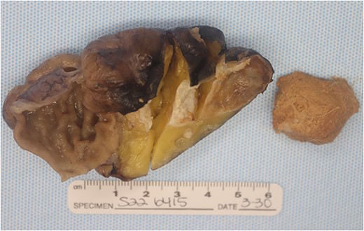 Gross pathology specimen showing a smooth walled cyst to the right of opened colon. The cyst was encased in fat and had no connection to the wall of the colon. There are no solid areas identified in the cyst. Separately, there is a ball of sebaceous material and hairs.