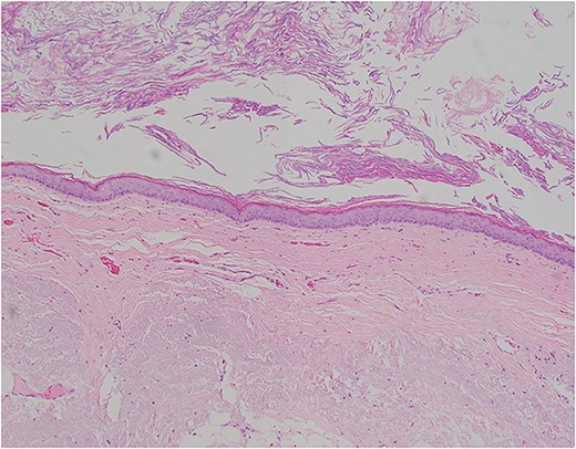 Pictomicrograph of an H&E-stained section of the cyst taken at 10× magnification. No solid areas were identified in the cyst, and no other tissue types were identified besides squamous epithelial lining within a thin wall of loose connective tissue. No cartilage, bone, or glandular tissues were identified. No immature or embryonic-type tissues were identified.