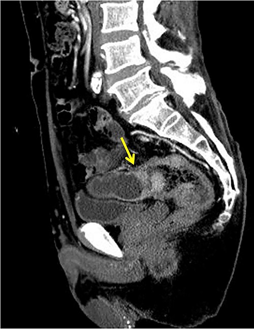 Fistula formation between the small intestine and the rectum was observed. Enlarged lymph nodes were also noted around the rectum.