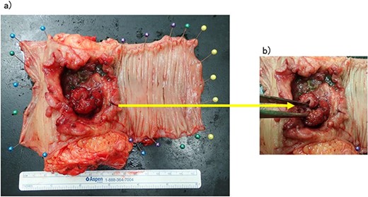 (a, b) Rectal cancer with small intestine invasion and fistula formation.