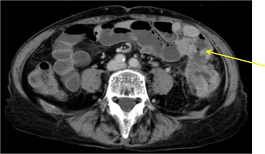 Descending colon with circumference tumor and small intestine invasion.