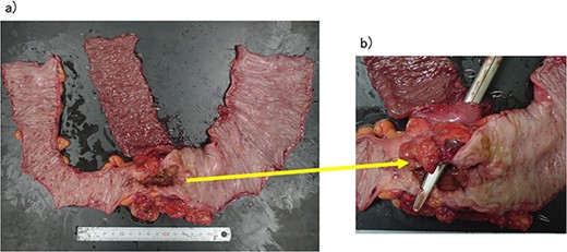 (a, b) Descending colon cancer with small intestine invasion and fistula formation.