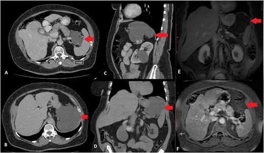CT scan of the abdomen. Transverse scan—mass between pancreas and spleen (A), Transverse scan—mass expanding below the diaphragm (B), Sagittal scan—mass below the diaphragm and over the tail of the pancreas and splenic vessels (C), Coronal scan—mass between the diaphragm, upper pole of the spleen and tail of the pancreas (D), MRI scan of the abdomen. Coronal scan—mass between the diaphragm, upper pole of the spleen and tail of the pancreas, not enhancing (E), Transverse scan—mass between pylorus, pancreas, and spleen (F) ( arrow marking the mass).