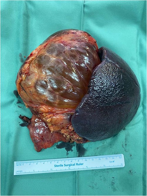 Surgical specimen of the distal pancreatospleenectomy en-bloc with the lymphangioma.