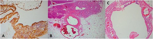 CD34 stain, ×100 (A), H–E, ×40 (B), and H–E, ×100 (C).