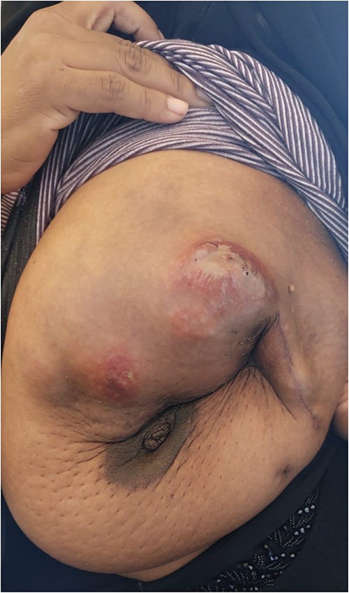 Breast lesion prior to commencing treatment.