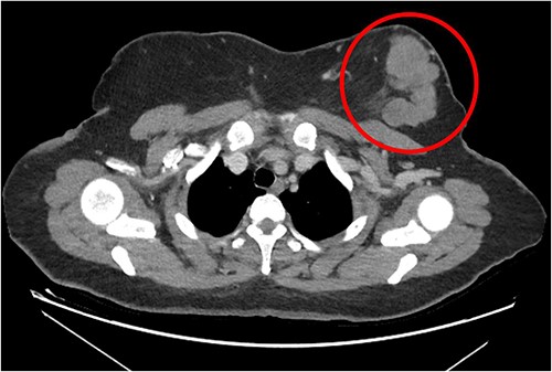 Breast mass seen on baseline CT scan, encircled.
