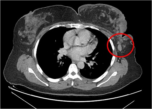 Left breast mass along with involved axillary lymph nodes, encircled.