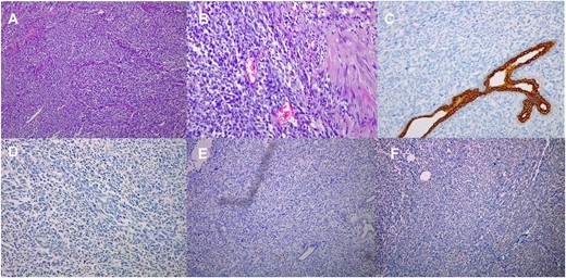 Histological images (10 × magnification) of the formalin-fixed paraffin-embedded sections (A) shows malignant spindle cell tumor with prominent cytological atypia. (B) shows malignant spindle cell tumor with prominent cytological atypia and pleomorphism. (C) Immunohistochmeically-stained slide of Ckpan showing negative reaction of tumor cells. (D) Immunohistochmeically-stained slide of ER showing negative reaction of tumor cells. (E) Immunohistochmeically-stained slide of desmin and myogenin showing negative reaction of tumor cells. (F) Immunohistochmeically-stained slide of CD56 showing negative reaction of tumor cells.