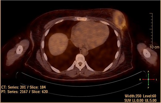 Hypermetabolic left breast mass in last positron emission tomography/computed tomography, following six cycles of IA.