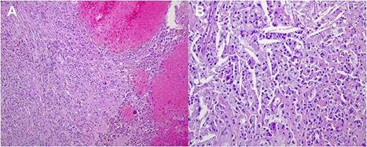 Histological images (20 × magnification) of the formalin-fixed paraffin-embedded sections. (A) shows no malignant cells and prominent interstitial hemorrhage with hemosiderin deposits due to treatment effect. (B) shows no malignant cells and numerous cholesterol clefts surrounded by foamy macrophages due to treatment effect.
