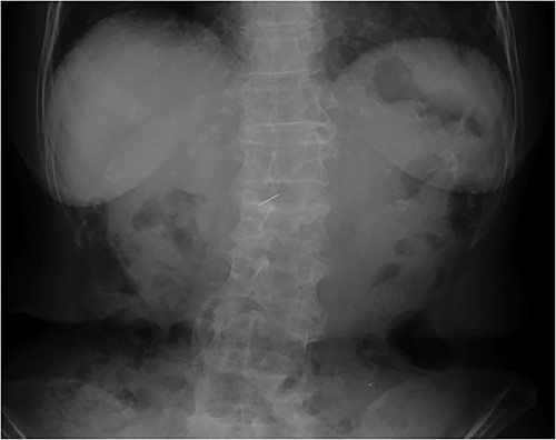 Plain abdominal radiograph displaying a needle-like metallic shadow at the second lumbar vertebral level.
