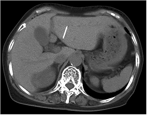 Abdominal CT scan displaying needle-like shadows obliquely lying in the left lateral segment of the liver.