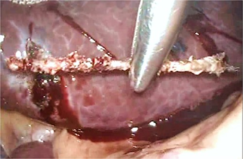 Extraction of the foreign body from the liver under laparoscopy surgery