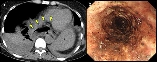 Previous conditions of the esophagus. Esophageal rupture accompanied by a massive mediastinal abscess (arrowheads). Necrotizing esophagitis of the lower esophagus.