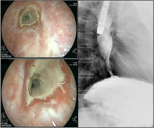 The scars continued down the esophagus, extending beyond 23 cm from the incisors, while the lower esophagus to the gastroesophageal junction was severely constricted.