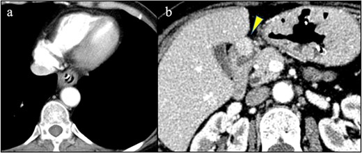 (a) No findings in the esophagus suggested malignancy. (b) A hypervascular mass was detected on the anterior wall of the duodenum (arrowhead).