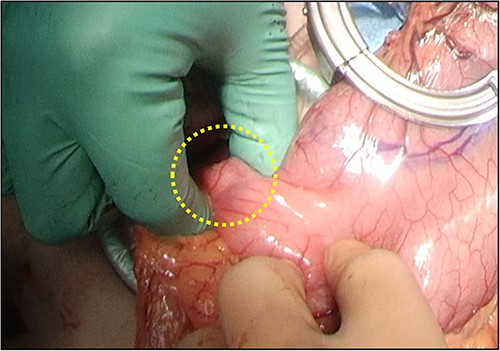 Partial duodenectomy was performed to resect the duodenal mass during mini-laparotomy.