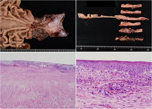 The constricted esophagus had a circumferential loss of squamous epithelium and a high degree of inflammatory cell infiltration. Residual squamous epithelium showed enlarged nuclei; it was determined to be reactive atypia associated with inflammation.