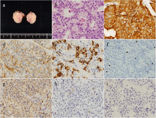The duodenal tumor (a) presented a rosette-like, trabecular-patterned proliferation of cells with round nuclei in the muscularis propria (b). Tumor cells were synaptophysin (+) (c), CD56 (+) (d), and chromogranin A (±) (e). MIB-1 index was 1.8%, and the mitotic count was 2/10 per high power field (f). Additional immunostaining presented gastrin (+) (g), somatostatin (±) (h), and insulin (−) (i). Altogether, the tumor was diagnosed as gastrinoma.