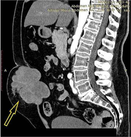 Contrast-enhanced abdominal computerized tomography with a tumor in the abdominal wall (arrow).