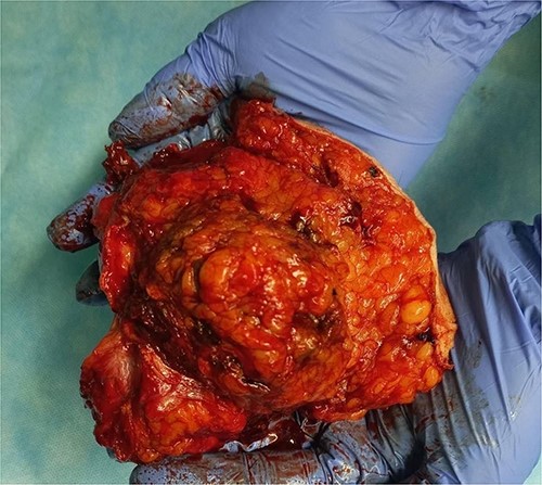 Excised specimen.