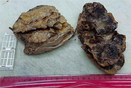 The nodular hemorrhagic cut the surface of the tumor.