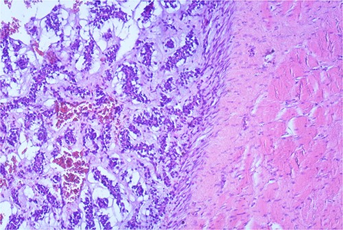 Tumor nodules infiltrate the muscle and fat tissue (HeEo, ×5).