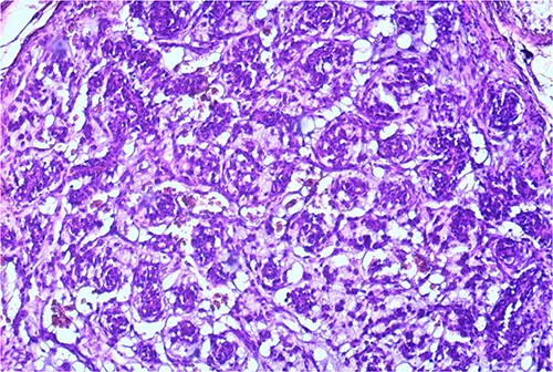 Small capillaries lined by relatively monomorphous round cells, with mild pleomorphism and sparse mitotic activity, surrounded by myxoid stroma (HeEo, ×100).