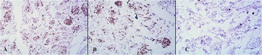 (A) SMA, ×100. (B) CD34, ×100. (C) Ki67, ×100.