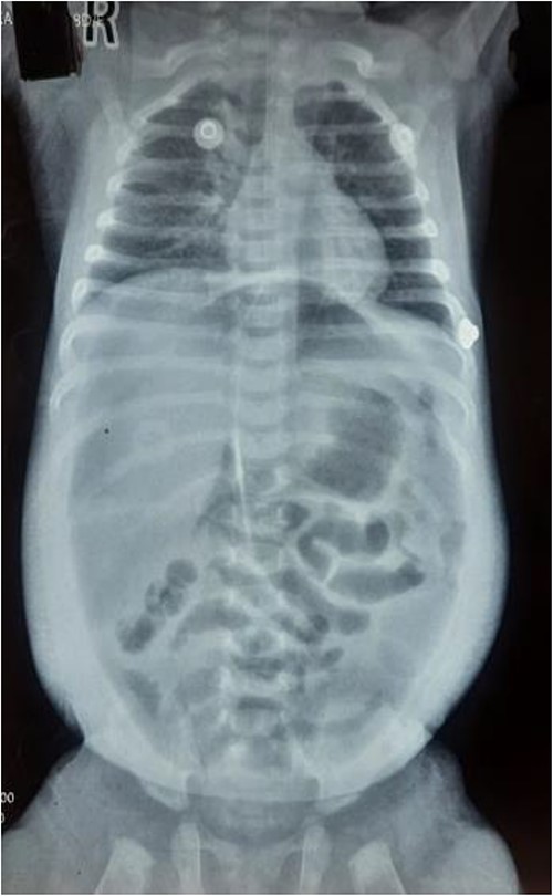 Supine X-ray showing chest and abdomen.