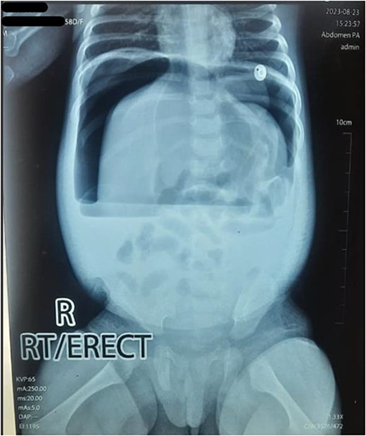 Erect X-ray showing pathological free gas under bilateral dome of diaphragm.