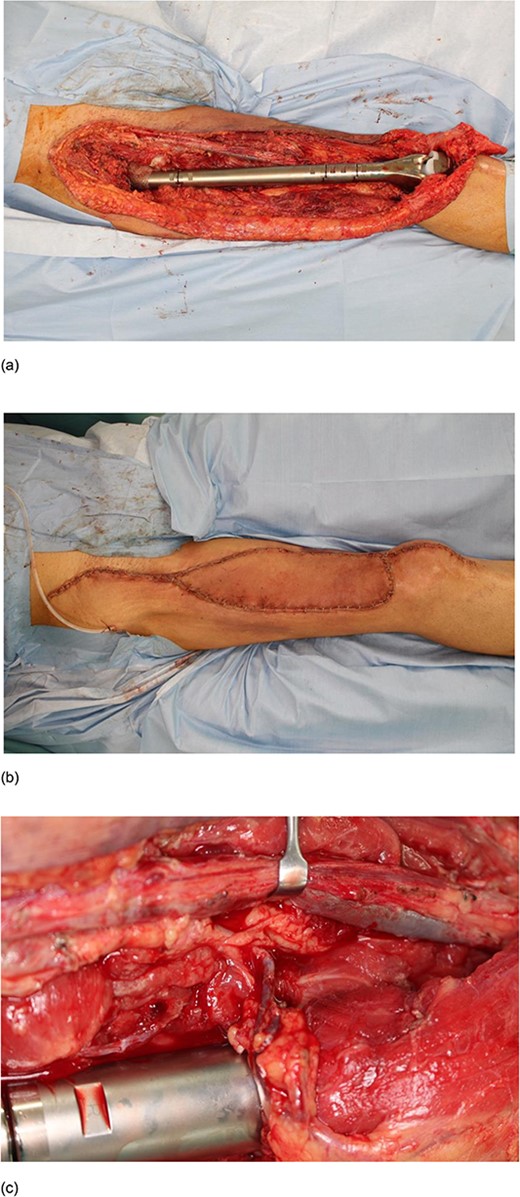 Intraoperative photographs of Case 1. A 59-year-old man underwent extensive tumour resection of the front of the thigh and reconstruction by free latissimus dorsi myocutaneous flap. (a) The skin defect on the front of the thigh after the extensive tumour resection. (b) Skin coverage after the reconstruction by free latissimus dorsi myocutaneous flap. (c) The thoracodorsal artery and vein, which feed the latissimus dorsi myocutaneous flap, were anastomosed to the second perforating branches of the deep femoral artery and vein, respectively.