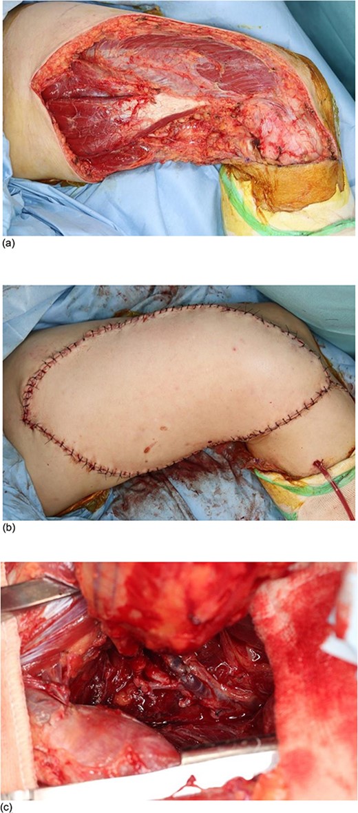 Intraoperative photographs of Case 2. A 53-year-old man underwent extensive tumour resection of the medial distal thigh and reconstruction by free latissimus dorsi myocutaneous flap. (a) The skin defect from the medial thigh to the medial knee joint after the extensive tumour resection. (b) Skin coverage after the reconstruction by free latissimus dorsi myocutaneous flap. (c) The thoracodorsal artery and vein, which feed the latissimus dorsi myocutaneous flap, were anastomosed to the terminal branches of the deep femoral artery and vein.